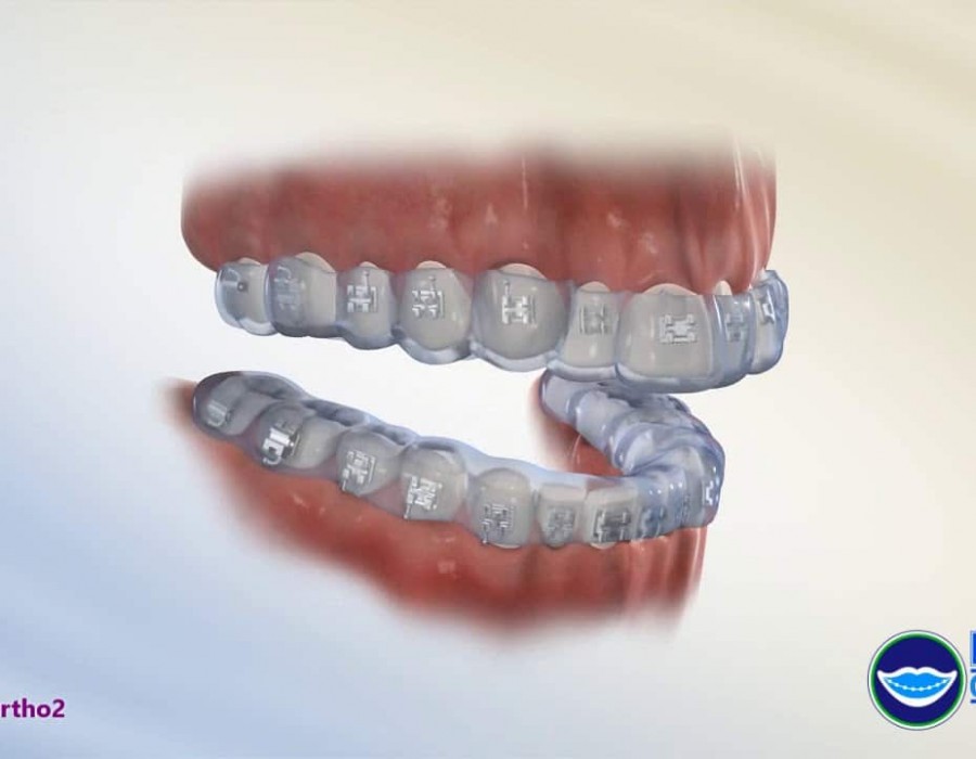 Whizolosophy Signs when Delta Dental Invisalign Coverage is required